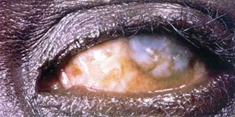 River Blindness River Blindness