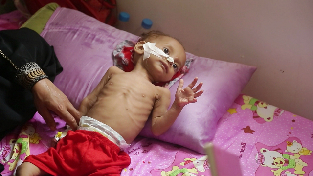 Starving Yemen Starving Yemen