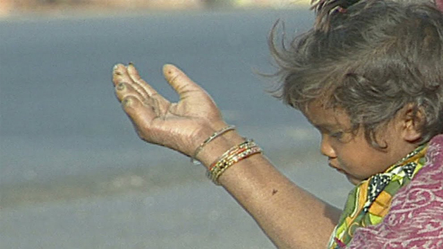 Leprosy Leprosy